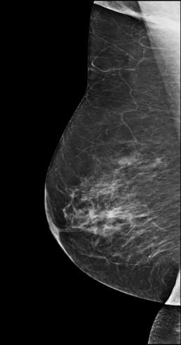 Case week 21 mammoscreen